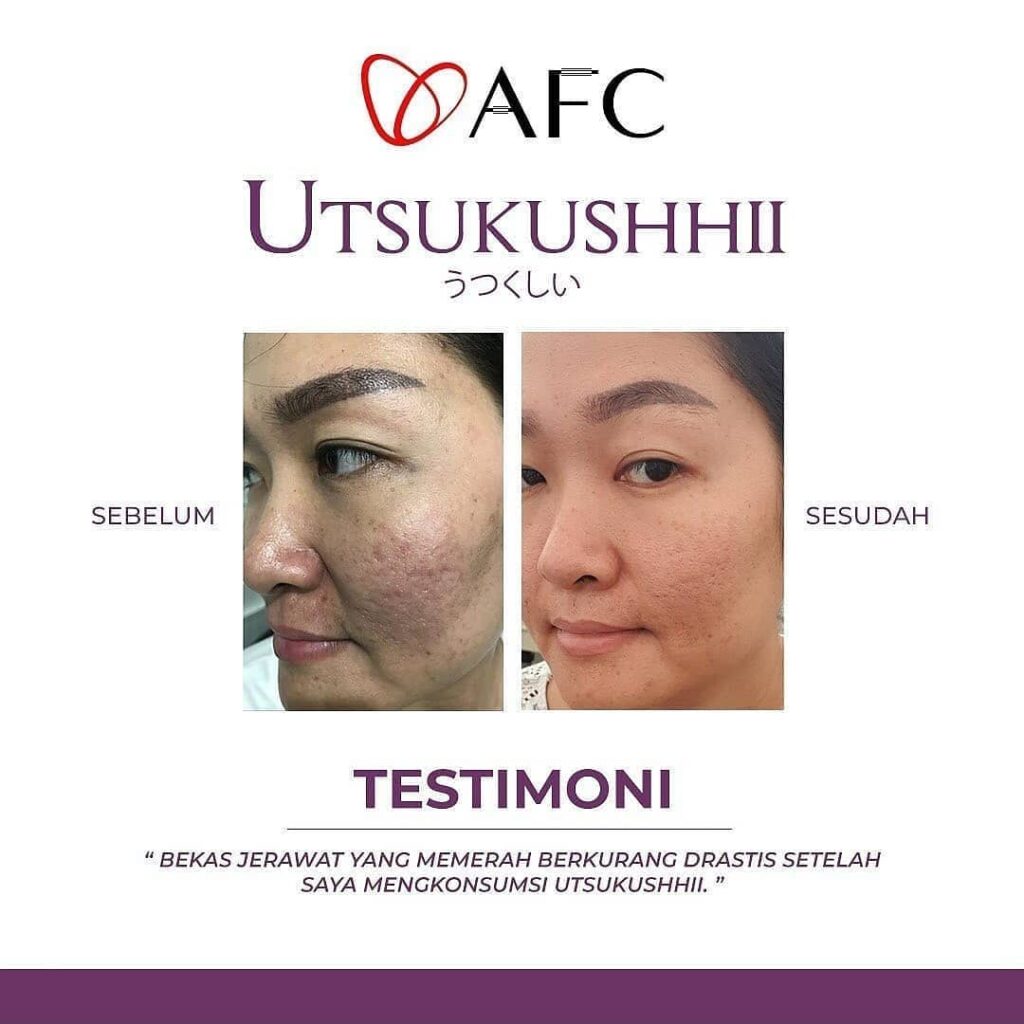 Jual Utsukushhii Gold Resmi – Imun & Kulit Sehat 37